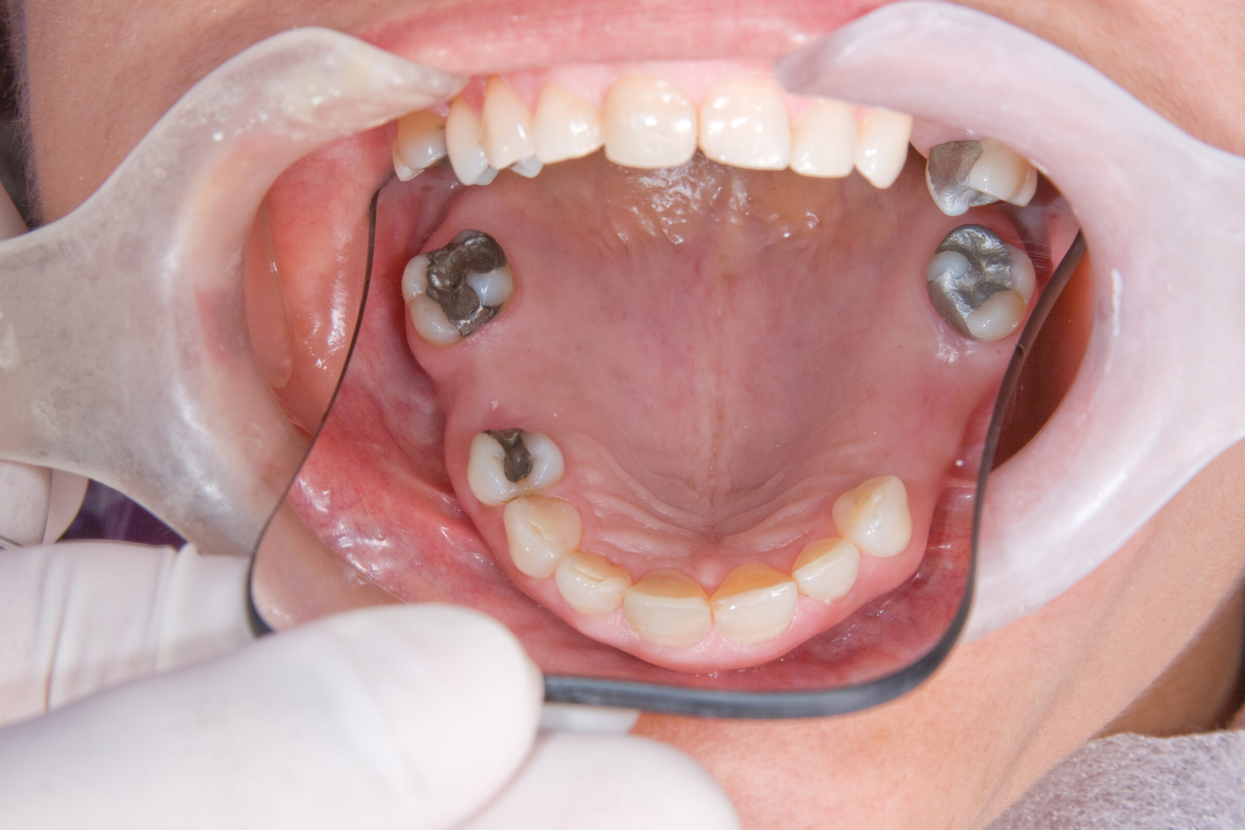 oral rehabilitation process, partial removable prosthesis