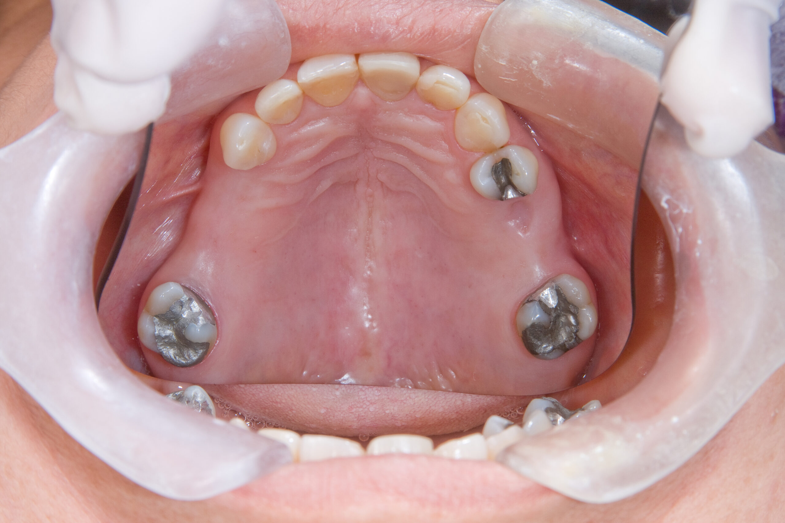 oral rehabilitation process, partial removable prosthesis