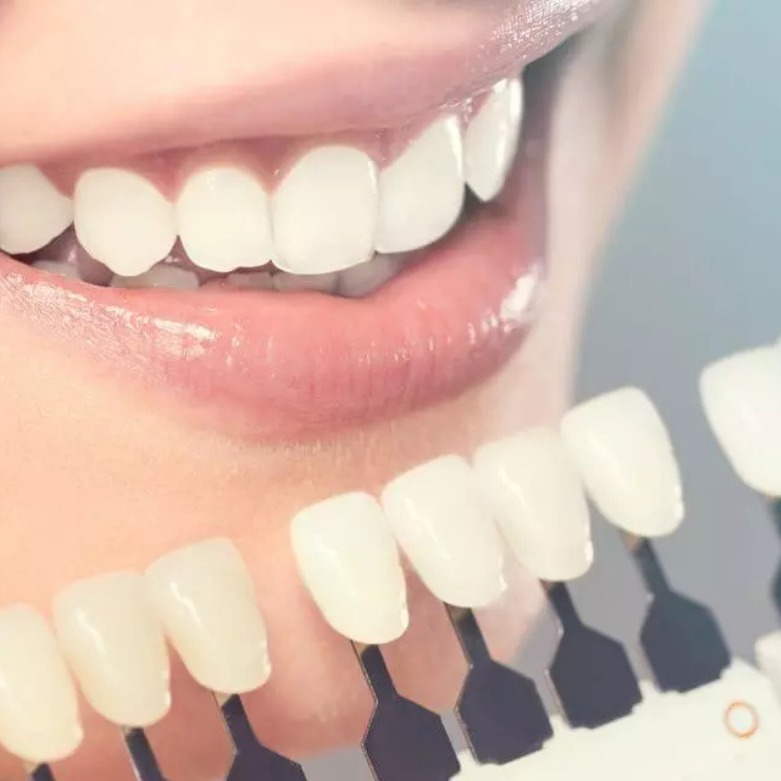 BLANCHIMENT DENTAIRE